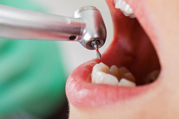 Best Emergency Tooth Extraction in Steele, AL